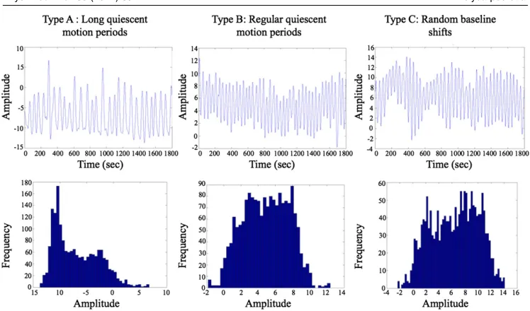 Figure 1. Breathing curves and corresponding displacement histograms for thethree breathing types: (a) long quiescent motion periods (type-A) accounting forapproximately 60% of the patients, (b) regular quiescent motion periods (type-B)accounting for approximately 20% of the patients and (c) random baseline shifts (type-C) accounting for approximately 20% of the patients.
