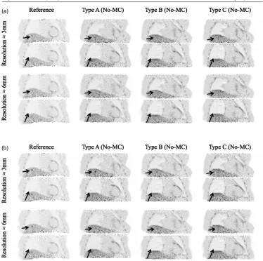 Figure 3. Coronal planes after reconstruction of the reference image and prior to motioncorrection (No-MC) of 20 mm under breathing of type-A, type-B and type-C
