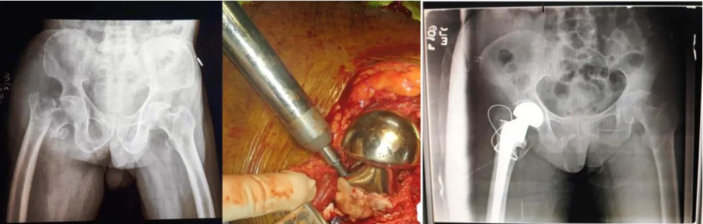 Figure No.3 IT fracture pre op, intra op and post op pictures(Bipolar prosthesis) 