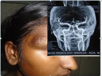 Figure 1: AV malformation involving right side of  face showing irregular pulsatile nodular lesion, inset 