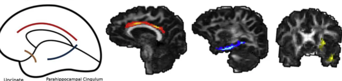 Fig. 1. Cartoon estimation of evaluated ﬁber tract regions of interest in neurite density analysis, as well as posterior probability distributions of cingulate gyrus cingulum, parahippocampal cingulum, and uncinate fasciculus ﬁber tracts as determined by T
