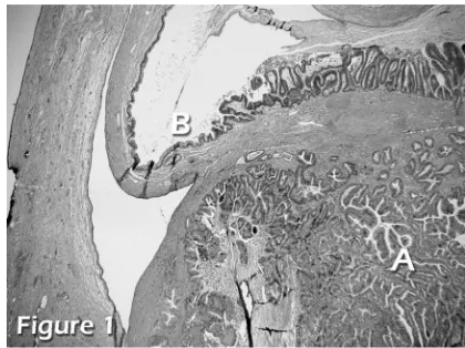 Figure 1. Histological section of gallbladder. A) an area of adenocarcinoma showing packed glandular formation; B) adjacent normal mucosa with uniform thickness and consistent invaginations