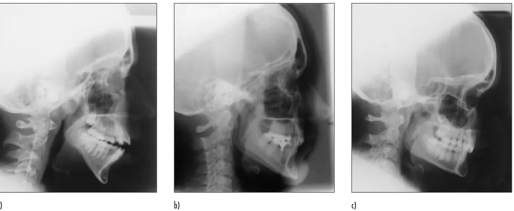 Fig. 2Tracing of cephalogram (a) showing a selection of cephalometric measurements and (b) the published means andstandard deviations (SD) for cephalometric measurements [2]