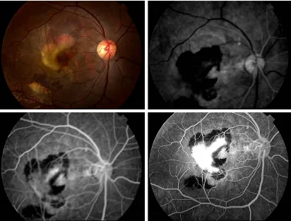 Figure 1 Fundus photograph and late FA phase demonstrating drusen.Note: FA shows fewer drusen than clinically identifiable.Abbreviation: FA, fluorescein angiography.