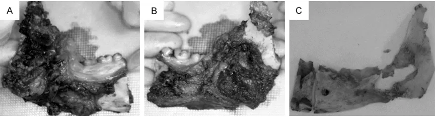 Figure 5. Resected specimen. A. Inner side surface view; B. Outer side surface view; C