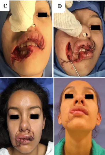 Figure 1: Clinical case 1.  ( A): Loss of skin coverage  from dog bite in lower lip involving commissure