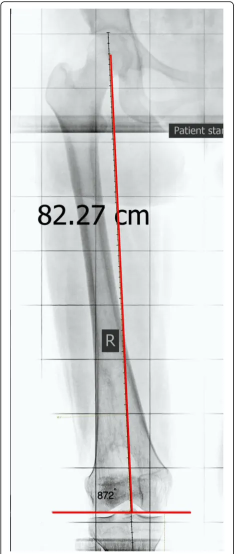 Fig. 3 Green arrowintercondylar notch points to the middle of the femur (midway betweenmedial and lateral cortices), blue arrow points to the center of the—original image, not previously used in any article
