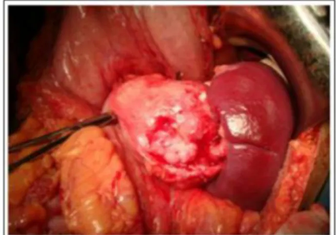 Fig  2:  Operative  features  of  SPN  in  tail  of  the 