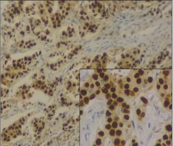 Figure 1: Strong nuclear positivity: Allred score of 8.  (IHC (ER): (20X)) inset (40X)