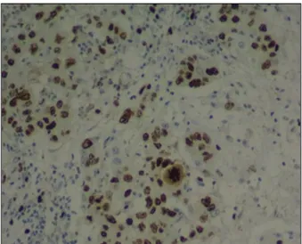 Figure 3: Strong, uniform, complete membrane  positivity in &gt;10% of tumor (3 + positivity) (IHC 