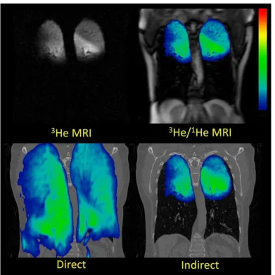 Figure 4. Corresponding coronal slices of patient 9 showing registered 3He MRI fused with CT via the direct (bottom left) and indirect (bottom right) diffeomorphic methods with preregistered 3He MRI (top left) and 1H MRI fused with 3He MRI (top right)