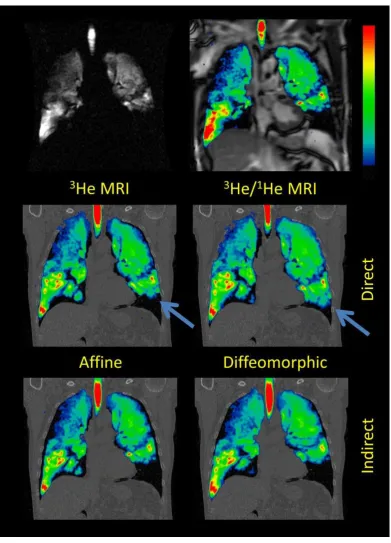 Figure 5. Corresponding coronal slices of patient 14 showing registered 3the base of the left lung indicates a registration error in the direct affine and diffeomorphic methods when compared to the corresponding slice of the unregistered the direct (middle