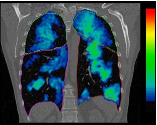 Figure 6. Example slice of patient 11 showing the CT lobar masks fused with 3He MRI after 
