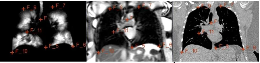 Figure 3. An example of corresponding landmarks identified on 1H MRI (middle) and CT (right) 