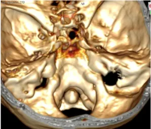 Fig. 10 VR3D of erosion of right petrous bone by 