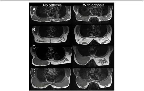 Figure 3 Assessment of mechanical forces. Plane view of loading through breast tissue without (A) and with the orthosis (B), where pressure(kPa) is distributed along the orthosis.