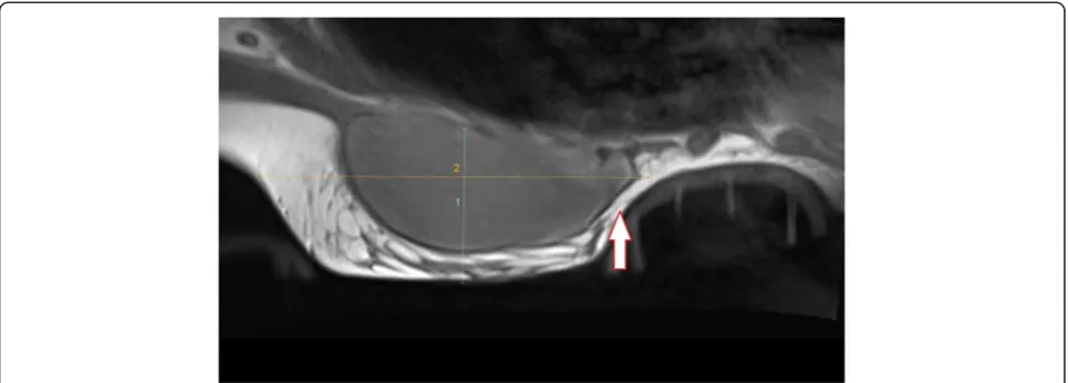 Figure 5 Sagittal MRI view mid-breast of an E-cup primary augmented individual in a size-1 device