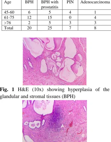 Table  1  showing  age-wise  distribution  of  prostatic 