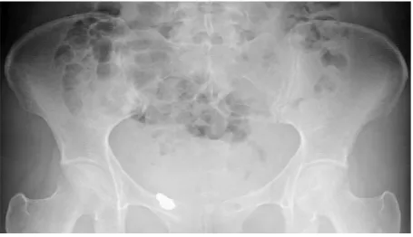 Figure 1. Abdominal radiography shows a high-density ma-terial within the pelvis. 