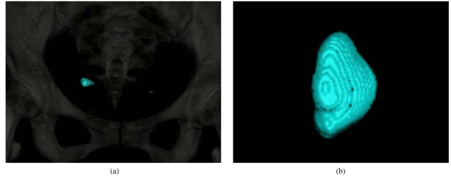 Figure 2. CT shows a high-density material with streak arti-fact to the right of the rectum