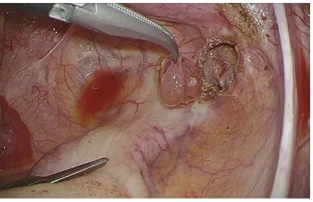 Figure 4. Intraoperative image of the cyst removed during laparoscopic surgery. 