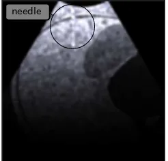 Fig. 5Needle in rendered ultrasound image (top left)