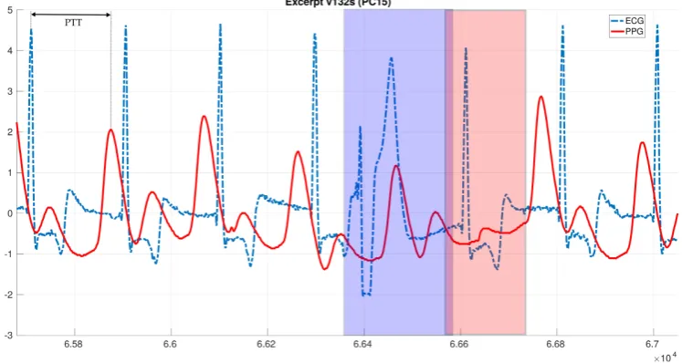 Figure 4. Excerpt of a synchronized recording of ECG (blue dash-dotted) and PPG (red solid) containing a singleectopic beat, highlighted with blue and red backgrounds respectively