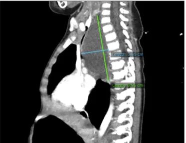Fig. 6.  Atresia of left bronchus due to chronic mass effect.