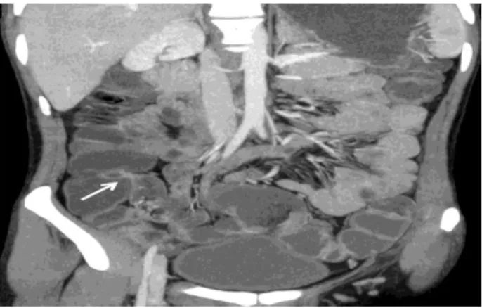 Table 2: Follow up and final diagnosis in patients undergoing CT Enterography.  CT enterography diagnosis  Type of 