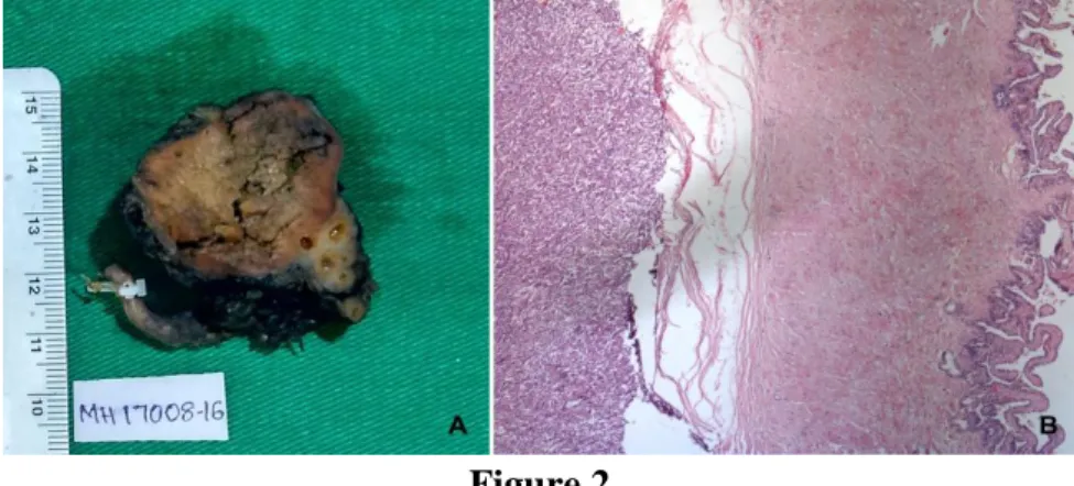 Figure 2  A- Excised mahogany brown tumor with adjacent seminal vesicle 