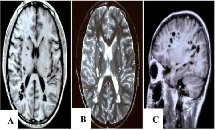 Figure 1: MRI scan of the cysts, demonstrating  hypointensity on T1WI (A) and hyperintensity on  T2WI (B) and showing isointensity as CSF
