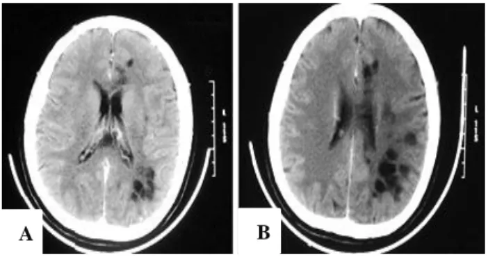 Figure 3: Brain image of CT, showing multiple  hypodense lesions, isointensity as CSF, and no       