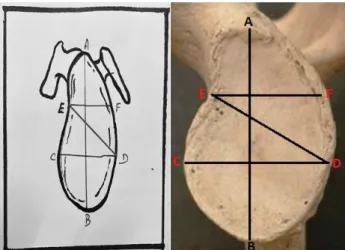 Figure 1: Prosthesis used in shoulder joint  replacement surgery. 