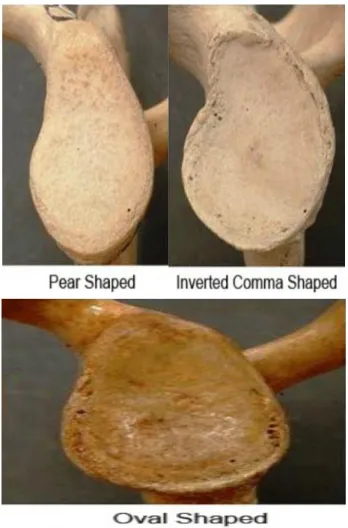 Figure 4: CT image of a glenoid cavity. A) Pear  shaped glenoid. B) Oval shaped glenoid