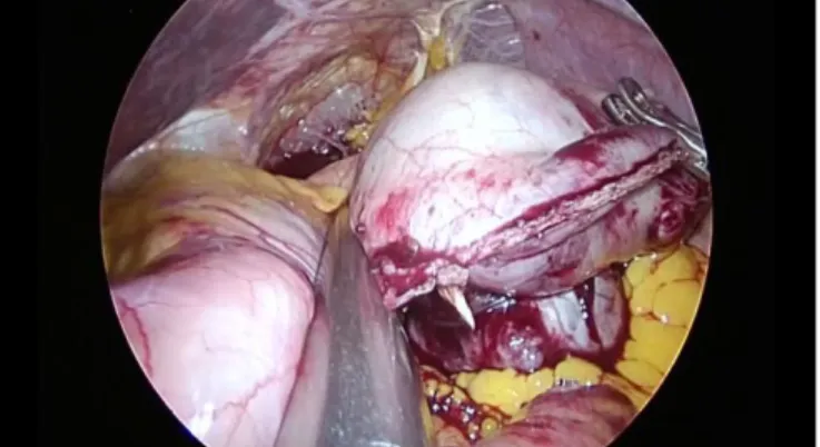 Fig 6: Wedge resection of gastric GIST after stapler firing  Table 8 Size of tumor and risk stratification  