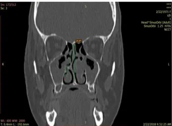 Figure 1: Coronal CT image showing measurement of  angle of the septal deviation (ASD) -line drawn from  the crista Galli to anterior nasal spine of maxilla and  another line from the crista Galli to the most deviated 