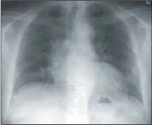 Fig. 2b. Expiratory HRCT film in patient  with acute HP due to pigeons showing patchy  gas trapping (mosaic attenuation pattern)