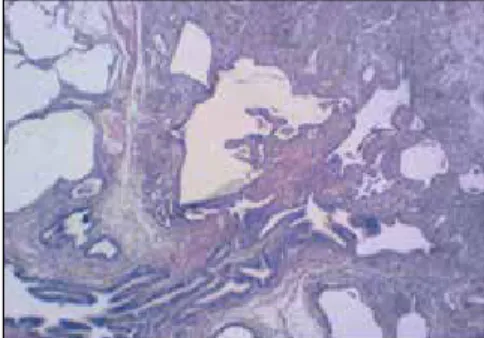 Fig. 3a. Low-power image of a surgical lung  biopsy in a patient with chronic HP showing  patchy peribronchiolar inflammatory process.