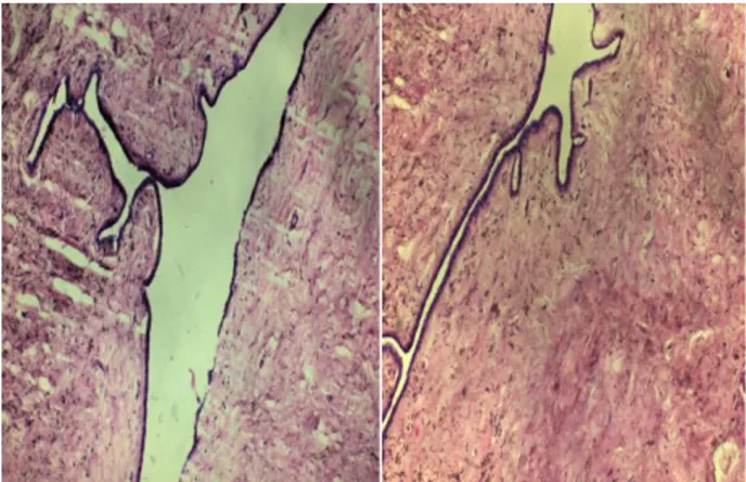 Figure 1: Photomicrographs of breast. A) 10X view of  H&amp;E stained phyllodes showing leaf like pattern