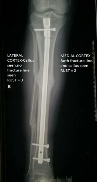 Fig 2 Intraobserver scores by the first orthopedic surgeon for prospective cases at 6 weeks 