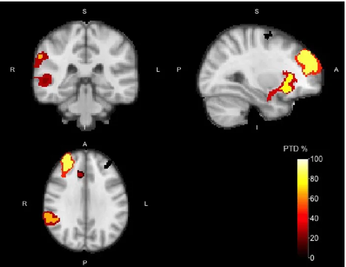 Figure 2: Activation map of the No-go > Go contrast with cluster-forming threshold Z > 4 for the Go/No-go data overlaid to the Z > 3.2 map