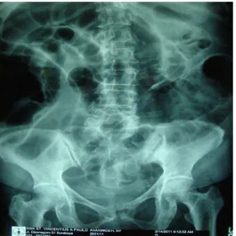 Figure 1. Plain abdominal X-Ray show dilatation of small and large intestine.                             