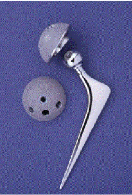 Figure 1 – Ulitma TPS™ MoM total hip replacement used in the Norwich cohort