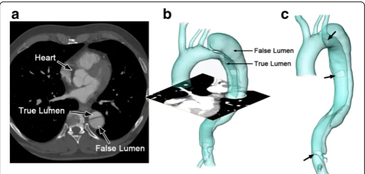 Figure 1 The reconstructed surface of the aortic dissection. (a) is one axial slice of the CT scan; (b) isthe reconstructed surface of the aortic dissection; (c) shows the positions of the entries along the flap(indicated by arrows).