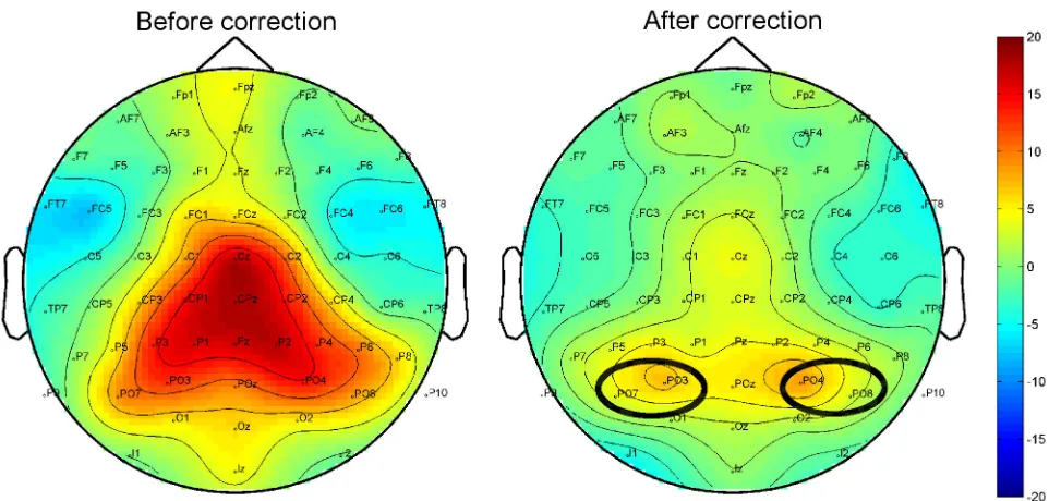 Figure 2.  stimulus onset. Ovals indicate electrodes selected for further analysis of total GBA.Total gamma band activity topography before and after miniature eye movement correction