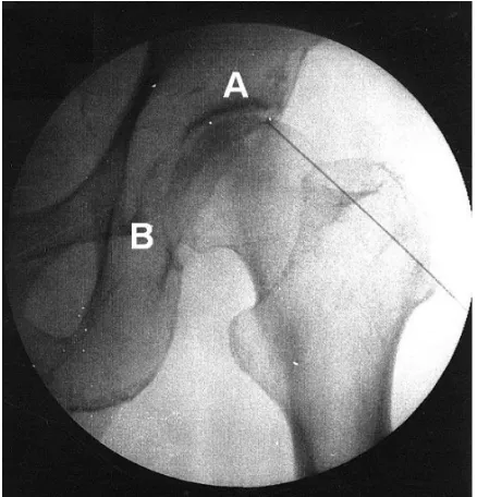 Figure 1 Fluoroscopic image showing radiofrequency cannula toward the articular branches of the femoral nerve (A) and the obturator nerve (B).