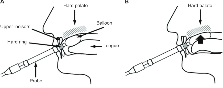 Figure 1 Tongue–palate pressure test.