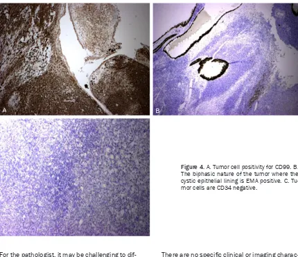 Figure 3. A. Low power view of the tumor shows monomorphic spindle cell proliferation and focal cystic areas