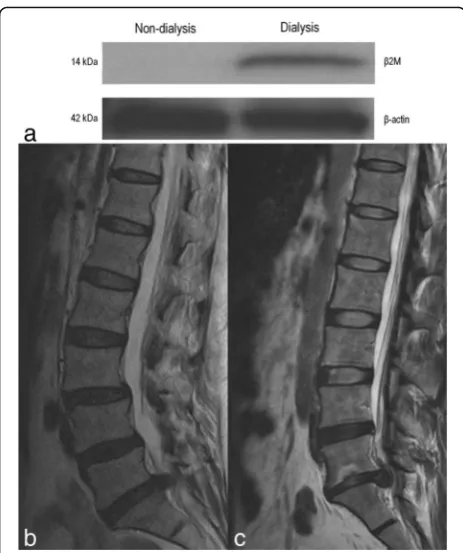Fig. 2 Western blot analysis of the intervertebral disc tissues of onethe non-dialysis patient showed the right L5/S1 herniated nucleuspulposus with grade III degeneration.the dialysis patient showed left L5/S1 extrusion type herniatedusing beta-actin as a