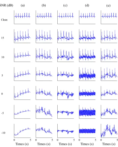 Figure 1. The real ECG recordings and the artificial synthetic noisy ECG recordings with SNR from -10 to 15 dB: (a) The real and the clean plus BW noise; (b) The real and the clean plus EM; (c) The real and the clean plus MA; (d) The real and the clean plu